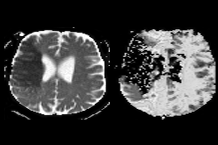 ADC MTT ct scan سکته مغزی